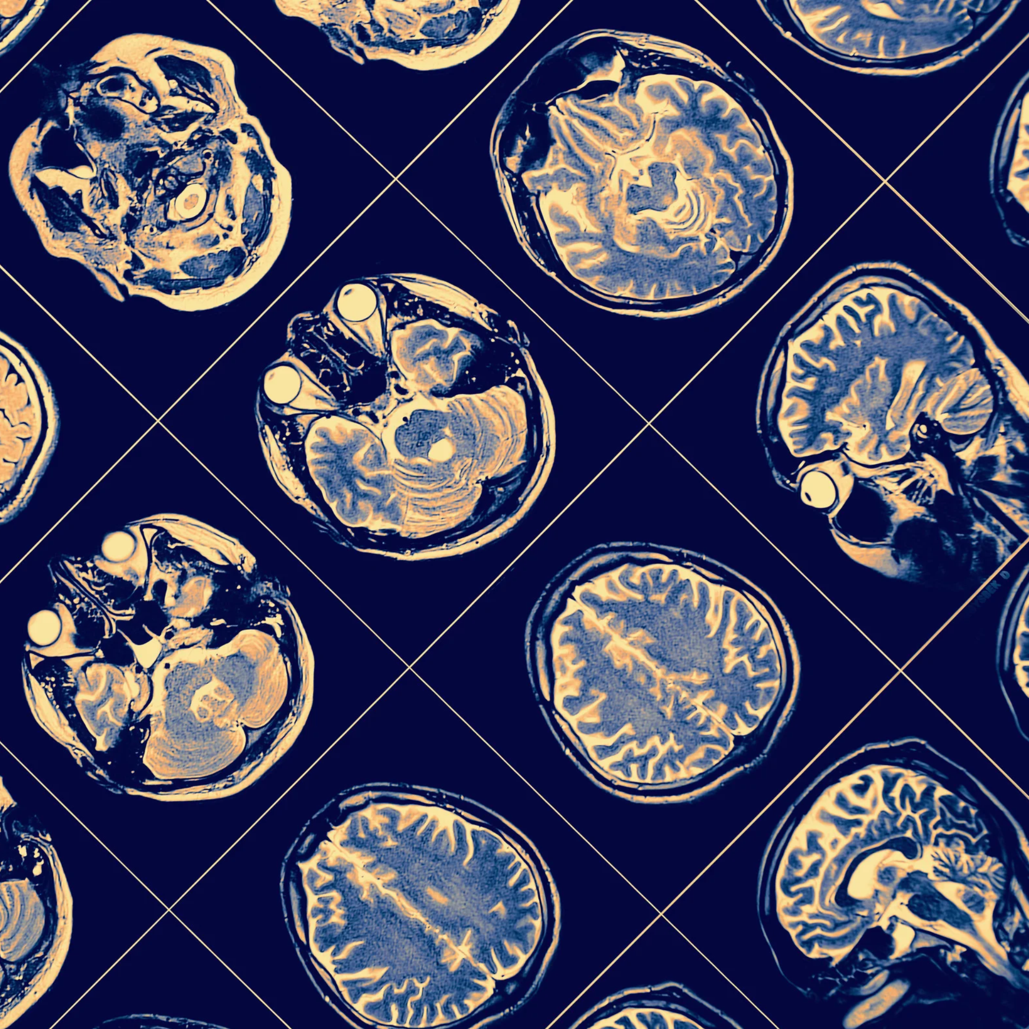EPU neuroradiologie